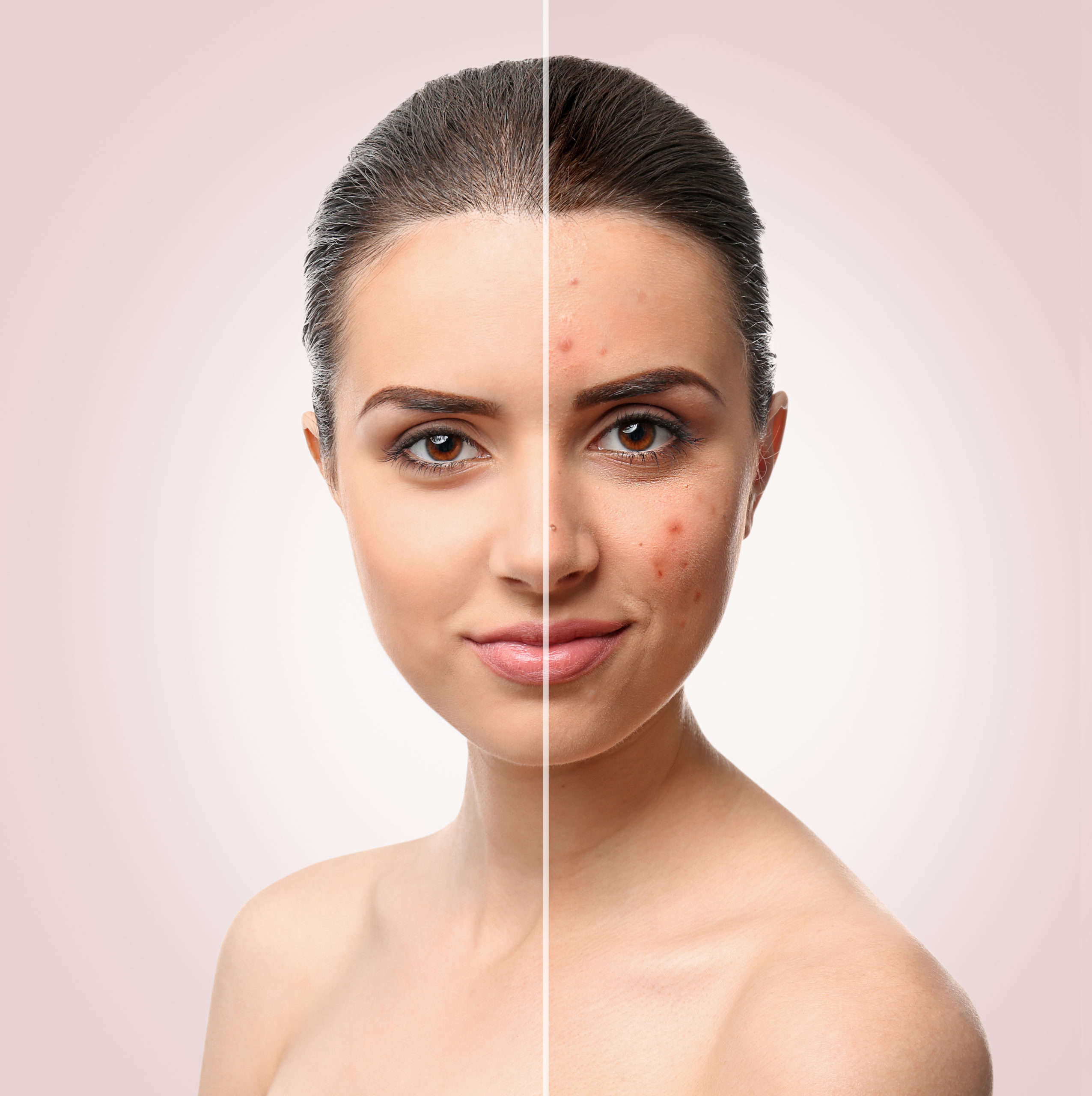 Woman face before and after acne treatment procedure