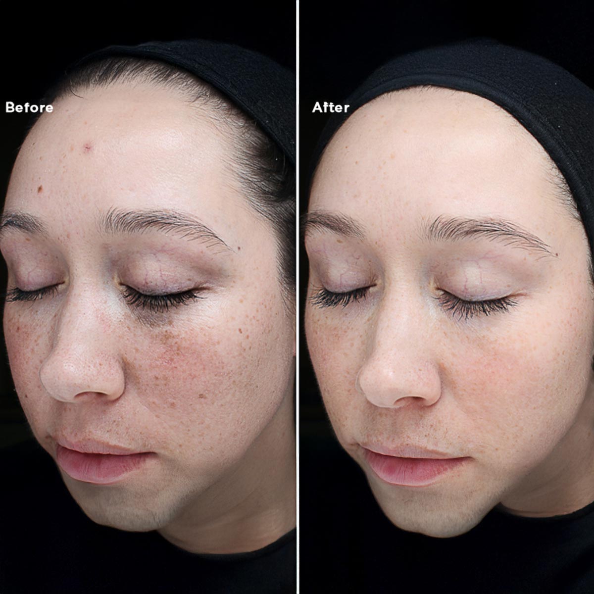 chemical peel treatment Orlando.