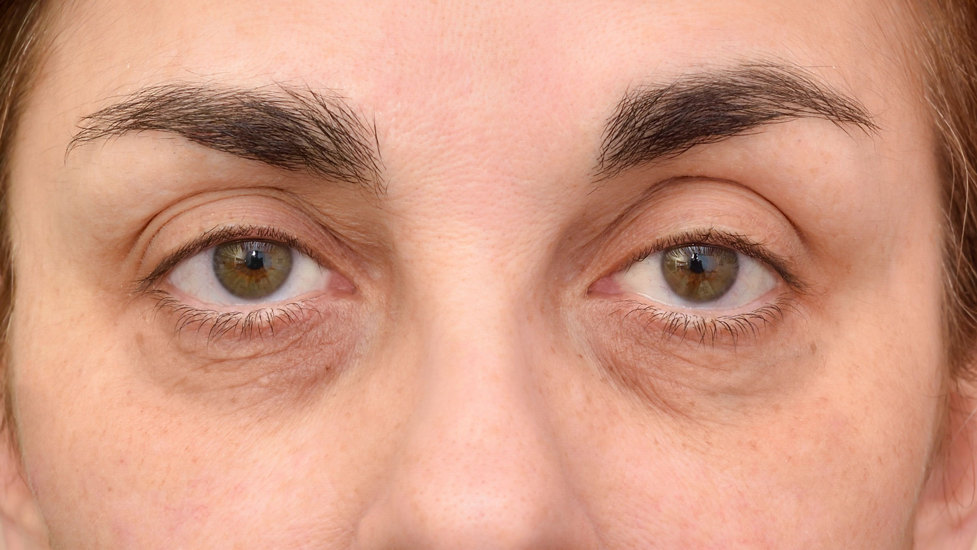 woman face wrinkles before and after treatment woman face wrinkles before and after treatment