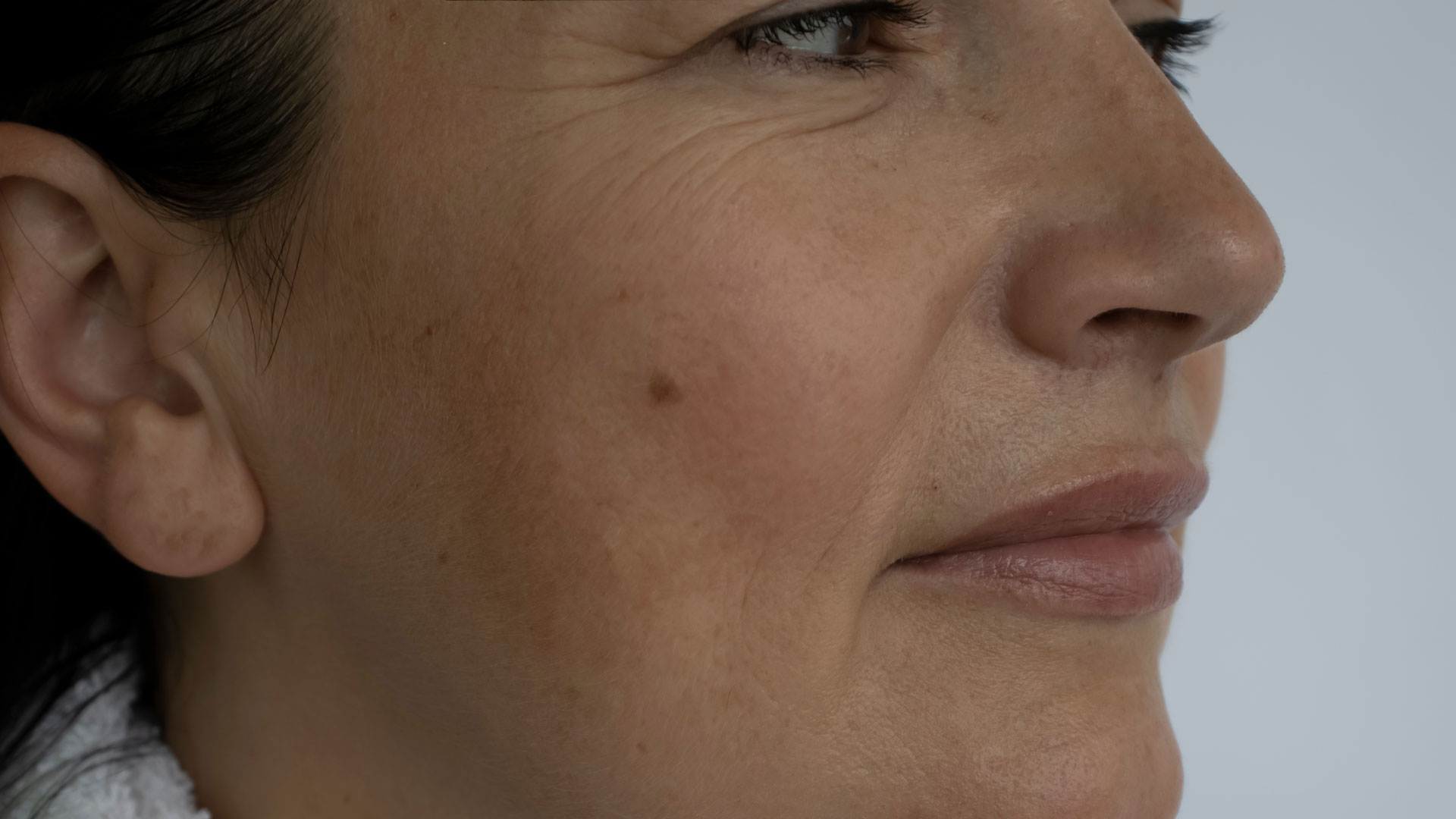 woman face wrinkles before and after treatment woman face wrinkles before and after treatment