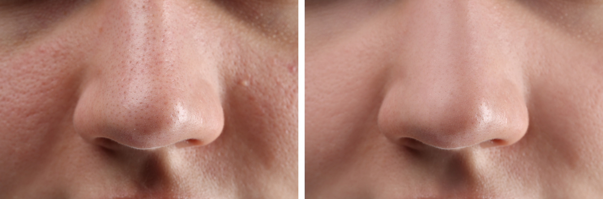 Photos of woman before and after acne treatment, closeup