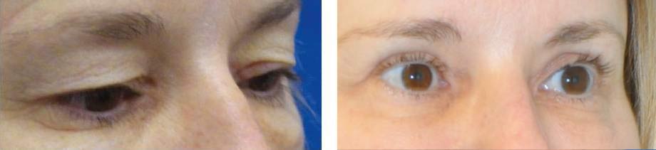 blepharoplasty-upper-eyelid-surgery-48-year-old-female-1
