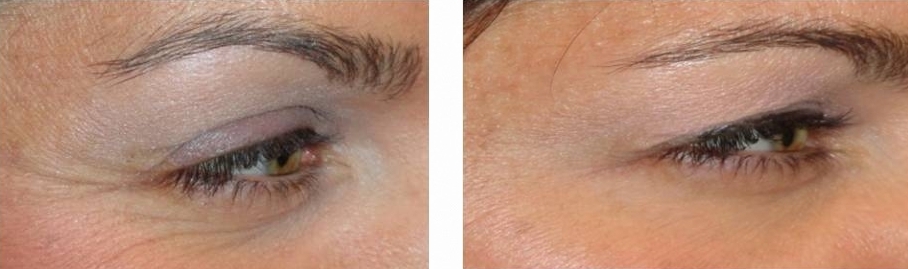 botox-for-eyes-crows-feet-before-and-after