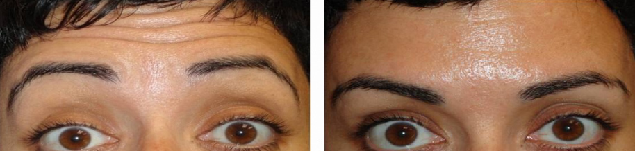 botox-for-forehead-lifting-brows-before-and-after