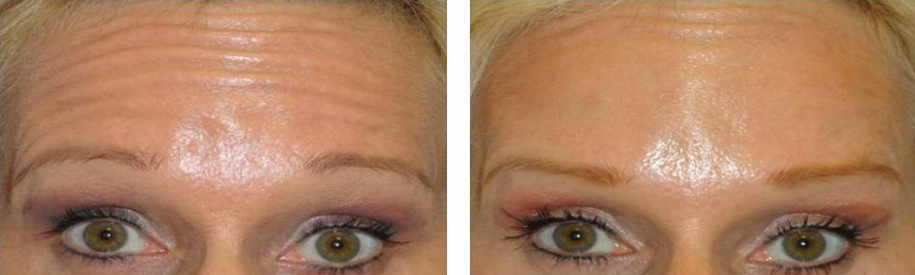 botox-for-forehead-lines-before-and-after