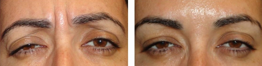 botox-for-frowning-before-and-after