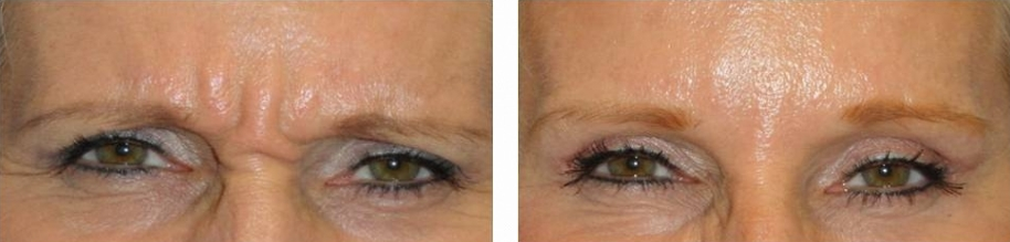 botox-for-woman-over-45