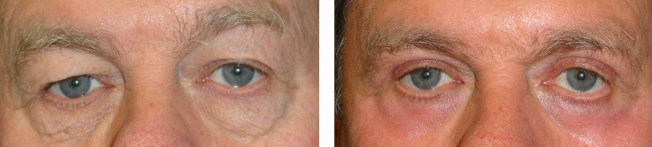 eyelid-lift-before-and-after-man-over-45