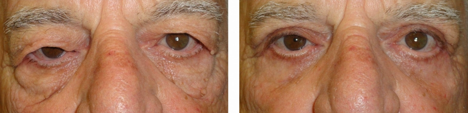 eyelid-lift-before-and-after-man