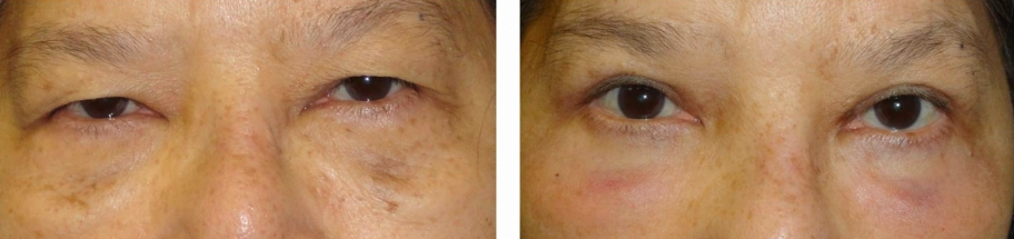 eyelid-lift-before-and-after-woman-between36-45
