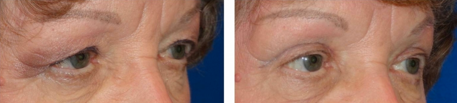 eyelid-lift-before-and-after-woman-over-45-2