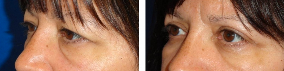 eyelid-lift-before-and-after-woman-over-45