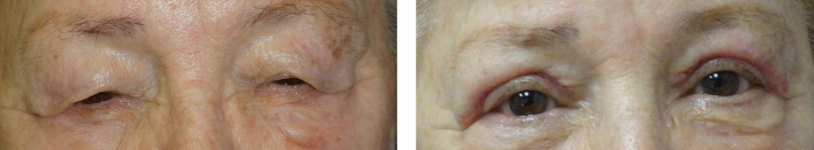 eyelid-lift-before-and-after-woman-over-65