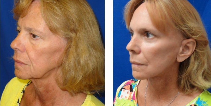 Facelift Before and After Patient Photo for Woman Over 60