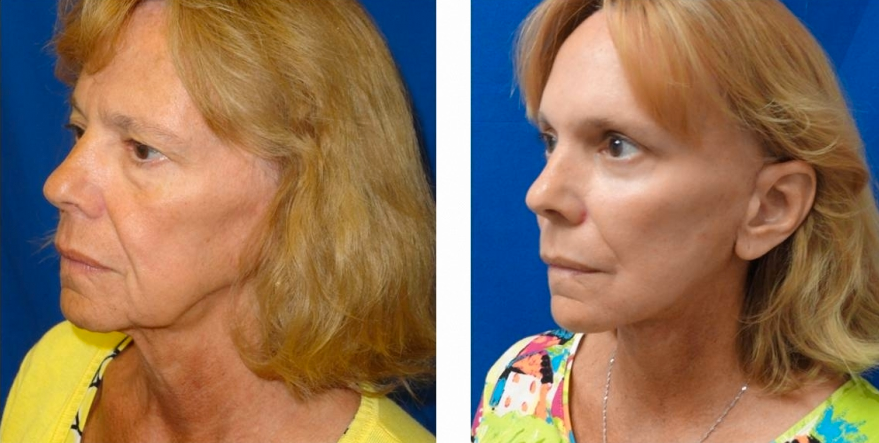 facelift-before-and-after-woman1