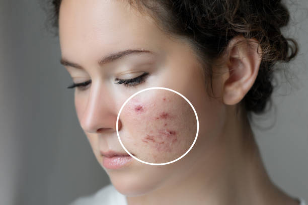 Microneedling for Acne Scars