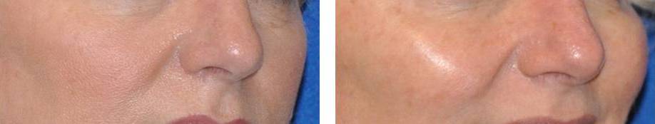 orlando-juvederm-cheeks-51-year-old-female