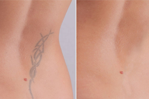 Before and after comparison of tattoo fading post-removal treatment in Winter Park