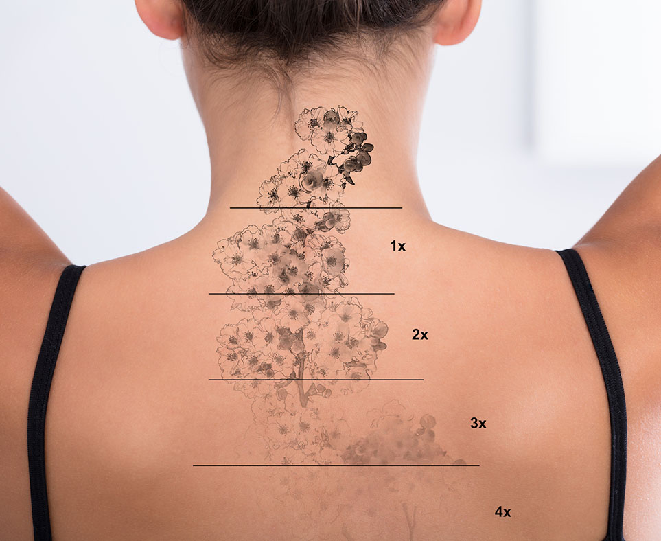 Client's back showing the fading of a tattoo after laser tattoo removal in Orlando treatments