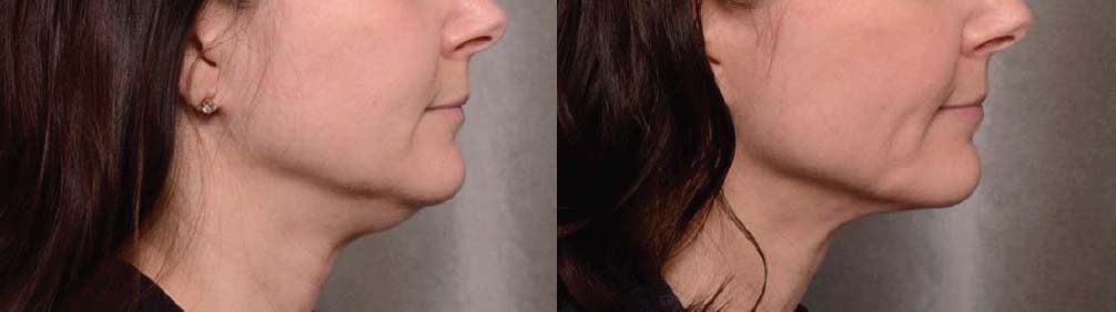 thermitight-before-and-after-results-42-yr-woman-six-months