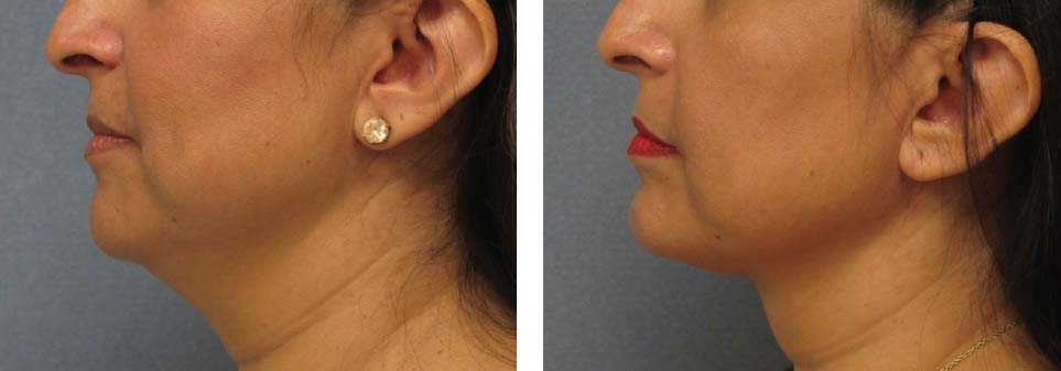 thermitight-before-and-after-results-woman-6-months