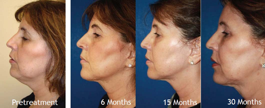 thermitight-before-and-after-results-woman