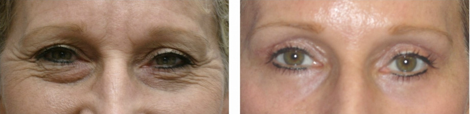 upper-and-lower-blepharoplasty-540yr-old-female